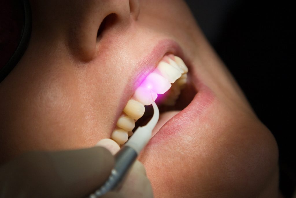 Laser-Assisted Root Canal Therapys