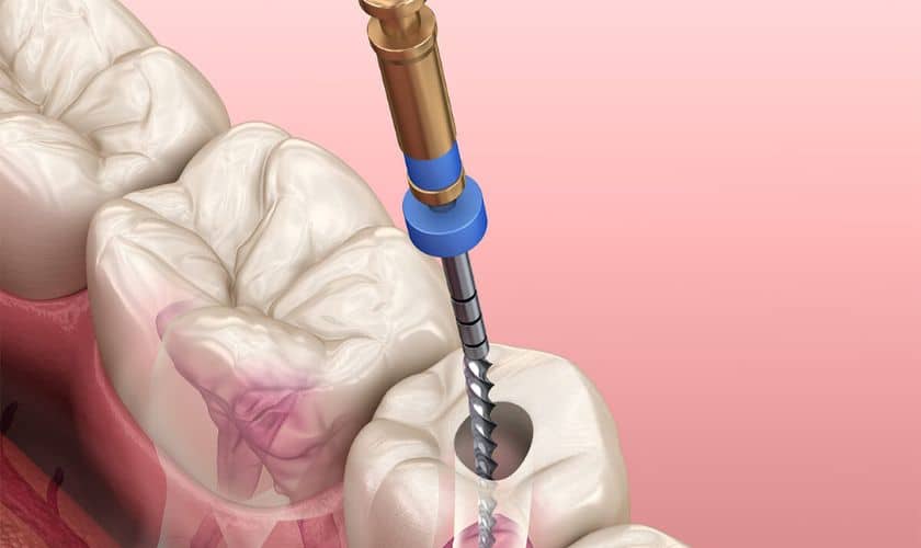 Laser-Assisted Root Canal Therapys